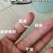孕期手上有湿疹怎么办（手上湿疹怎么解决）