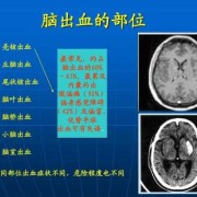 胎儿颅内出血（胎儿颅内出血原因）