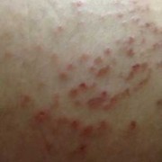 孕期湿疹多久能好啊（孕期湿疹多久能好啊图片）