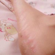 孕期脚蜕皮（孕期脚蜕皮起小疙瘩还痒）