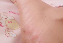 孕期脚蜕皮（孕期脚蜕皮起小疙瘩还痒）