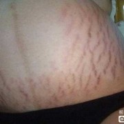 孕期妊娠纹（孕妇肚子有妊娠纹怎么回事）