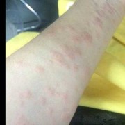 孕期发痒（孕期发痒红点）