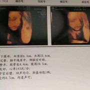 四维B超单上写着胎儿生物物理相评分8分是什么意思,胎儿8个月四维彩超图