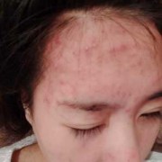 孕期不长痘痘（以前不长痘痘，为什么怀孕后长痘痘呢）