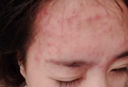 孕期不长痘痘（以前不长痘痘，为什么怀孕后长痘痘呢）