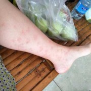 孕期腿痒（孕期腿痒怎么回事）