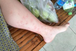孕期腿痒（孕期腿痒怎么回事）