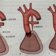 胎儿肺囊腺瘤怎么办,胎儿肺动脉异位