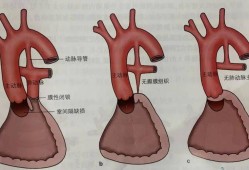 胎儿肺囊腺瘤怎么办,胎儿肺动脉异位