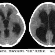 胎儿 脑积水（胎儿脑积水能够自己吸收的几率有多大）