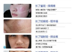 妊娠斑如何治疗,孕期长黄褐斑什么原因
