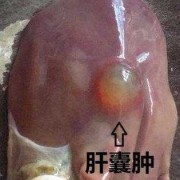 胎儿肝囊肿会消失吗（肝囊肿会不会自己消掉）