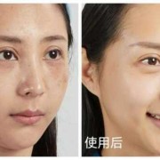 孕期怎样祛斑（孕期怎样祛斑最有效）