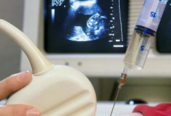 孕妇抽羊水检查对胎儿有危害吗,孕妇做羊水穿刺对胎儿有影响吗