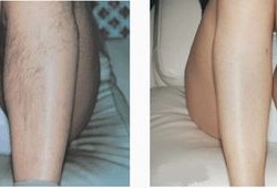 怀孕期间可以拔腿毛吗（女生说拔腿毛什么意思）