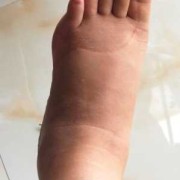 孕期手肿痛（孕晚期睡醒后手浮肿是怎么回事呢?我确定我没压到手，怎么办呢）