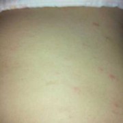 孕期胸部瘙痒（孕期胸部瘙痒）
