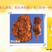 胎儿偏小 染色体（什么是染色体畸变CNV）
