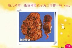 胎儿偏小 染色体（什么是染色体畸变CNV）