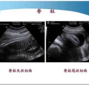 胎儿脊柱呈串珠样排列（胎儿脊柱呈串珠样排列是什么意思）