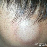 胎儿血肿（新生儿头皮血肿会引起黄疸高吗）