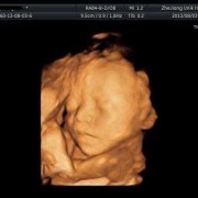 孕妇做四维彩超24周胎儿显示没有胆囊,孕期没做四维影响大吗