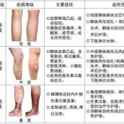 孕妇静脉曲张危险吗,孕期腿肿是什么原因引起的