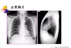 一次胸片不会影响胎儿（一次胸片不会影响胎儿）