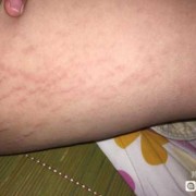 为什么孕妇腿上会长妊娠纹,孕期大腿有纹路