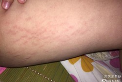 为什么孕妇腿上会长妊娠纹,孕期大腿有纹路