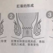 孕期肛门痛（孕期肛门痛什么原因引起的）