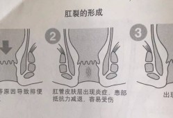 孕期肛门痛（孕期肛门痛什么原因引起的）