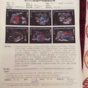 胎儿超声（胎儿心脏超声检查是什么）