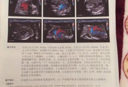 胎儿超声（胎儿心脏超声检查是什么）