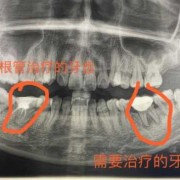 孕期拍牙片（孕期拍牙片,生下来小孩正常,对以后会不会有影响）