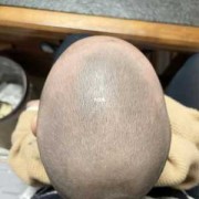 四个月宝宝舟状头还能矫正吗,胎儿颅骨呈舟状正常吗图片