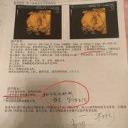 二十四周胎儿（孕24周侧脑室宽度标准）