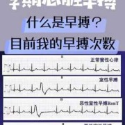 心脏早搏是怎么一回事,怀孕期间心脏早搏怎么办