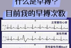 心脏早搏是怎么一回事,怀孕期间心脏早搏怎么办