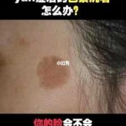 怀孕时的黑色素多久可以消,孕期黑色素沉淀产后多久恢复