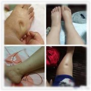 孕期脚踝肿（孕晚期脚肿是怎么回事）