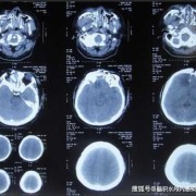 孕妇撞击致胎儿脑损伤（孕妇撞击致胎儿脑损伤）