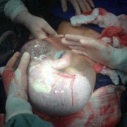 38周剖腹产对胎儿有影响吗（38周剖腹产对胎儿有影响吗会不会引起黄胆）