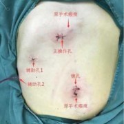 胎儿胆总管囊肿（胆总管囊肿术后可以恢复以前吗）