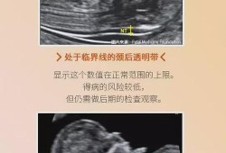 胎儿nt值增厚（nt增厚是什么原因导致）