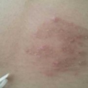 孕期皮肤癣（孕期皮肤癣）