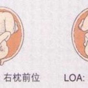 LOA是男孩还是女孩,胎儿头位loa图片