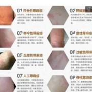 孕妇发荨麻疹怎么办,孕期荨麻疹怎么办呢图片