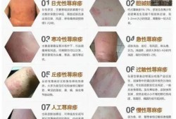 孕妇发荨麻疹怎么办,孕期荨麻疹怎么办呢图片